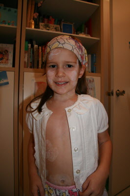 Our Chicken pox girl.