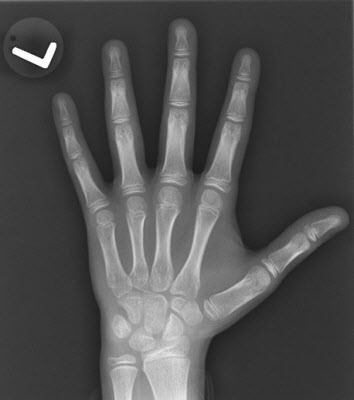 Lottie - broken finger